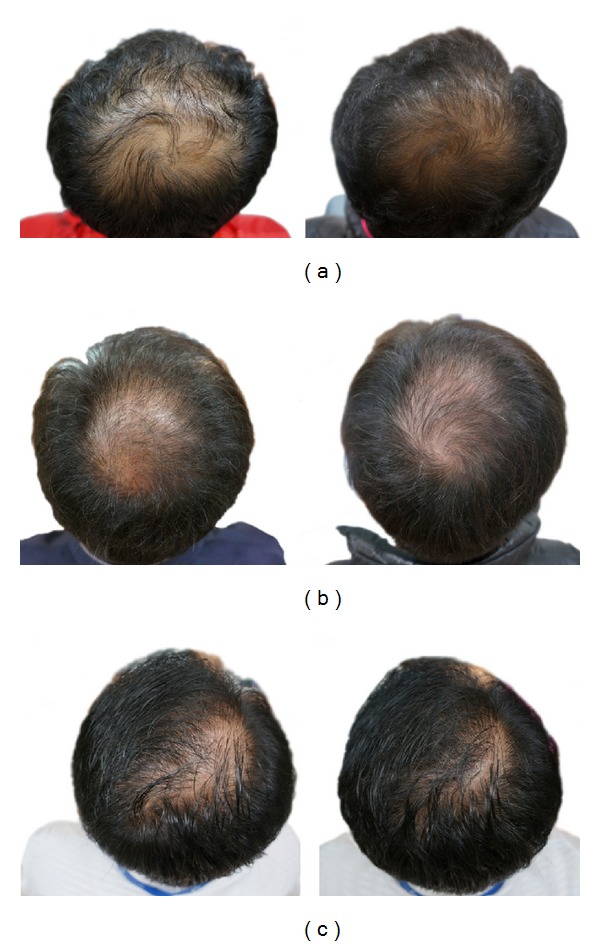 results of pumpkin seed oil on hair loss